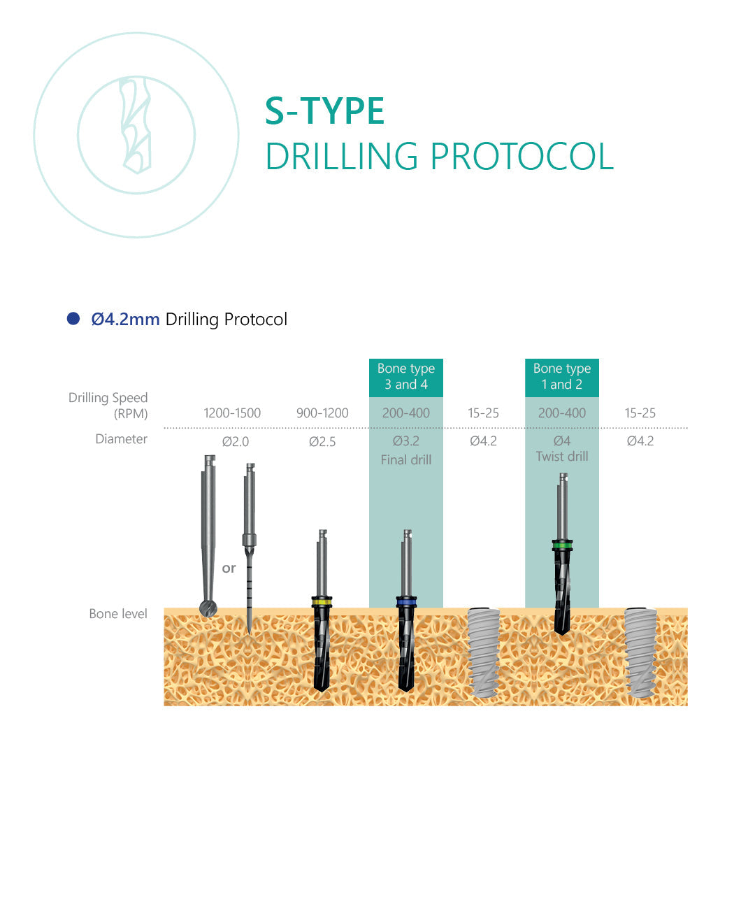 S-Type Dental Implant